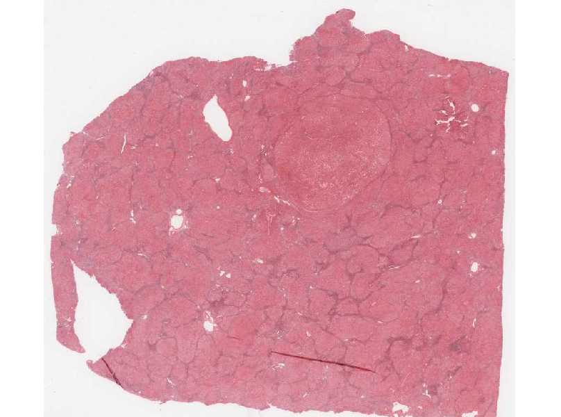 Liver1