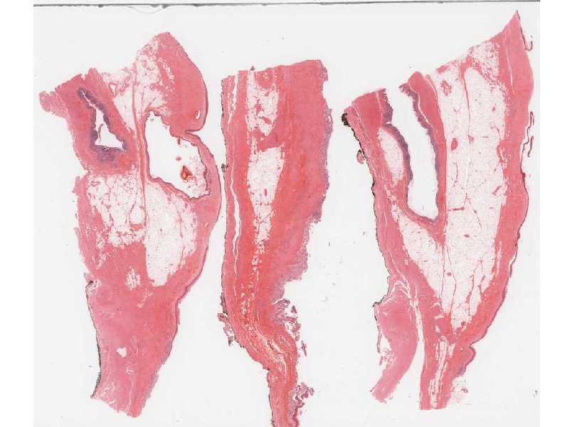 Ovarian Tumor