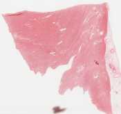 Myocarditis