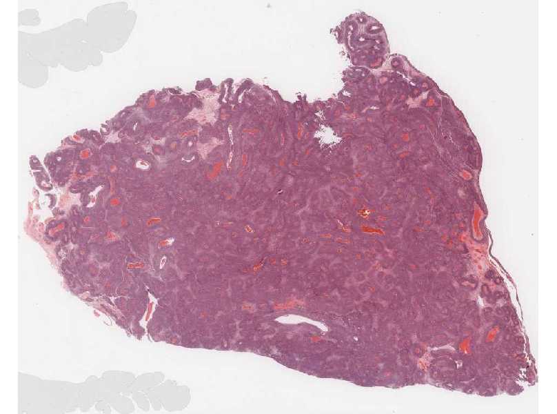 Ovarian Tumor