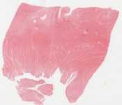 Acute Myocardial Infarction