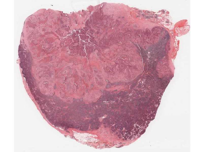 Ovarian Tumor
