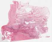 Acute Endocarditis