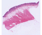 Ulcerative Colitis