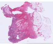 Linitis Plastica (Stomach)