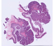 Adenoma