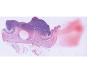 Adenocarcinoma.html