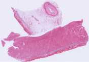Atherosclerosis of right coronary artery