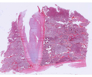Multiple myeloma (section of postmortem vertebral bone)