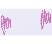Chronic hepatitis B with minimal activity and no fibrosis