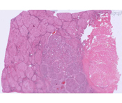 Chronic hepatitis C with mild activity and cirrhosis