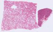 Sarcoidosis with interstitial fibrosis