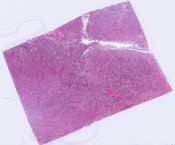 Bronchiolalveolar carcinoma