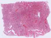Bronchopneumonia