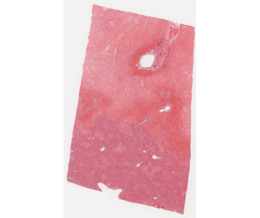 Liver (infarct)