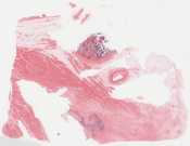 Atherosclerosis of right coronary artery
