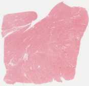 Healed myocardial infarct