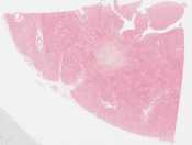 Amyloidosis