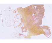 Linitis Plastica (Stomach with mucicarmine stain)