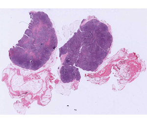 Reactive Lymph Node
