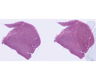 Follicular Lymphoma