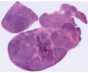 Hodgkin lymphoma
