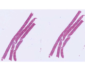 Acute Myocardial Infarction