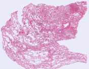 Emphysema