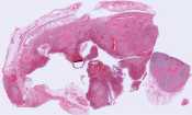 Tuberculous pneumonitis and lymphadenitis 