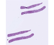 Adenocarcinoma.html